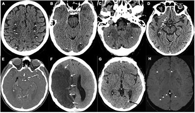 Neurological Disorders Associated With COVID-19 Hospital Admissions: Experience of a Single Tertiary Healthcare Center